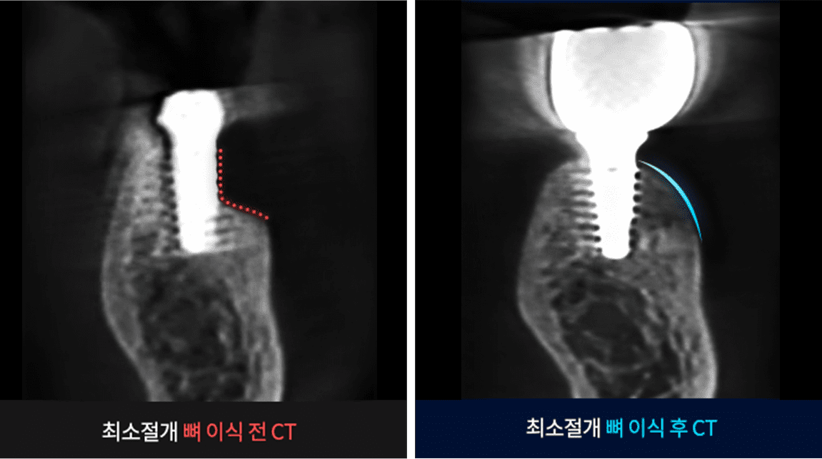 덜 침습적인 최소절개 뼈이식 전 후 CT 비교