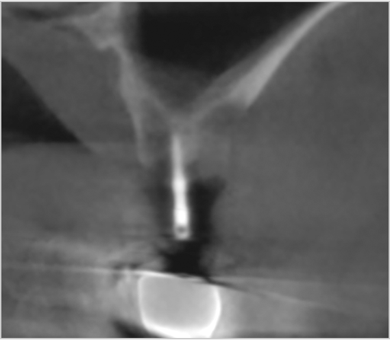 무절개 내비게이션 가이드 핀 삽입 후(좌측)