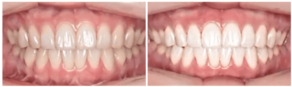 치아 미백 전후